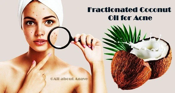 Fractionated Coconut Oil For Acne