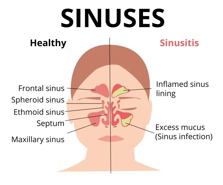 → Sinus & Respiratory Relief